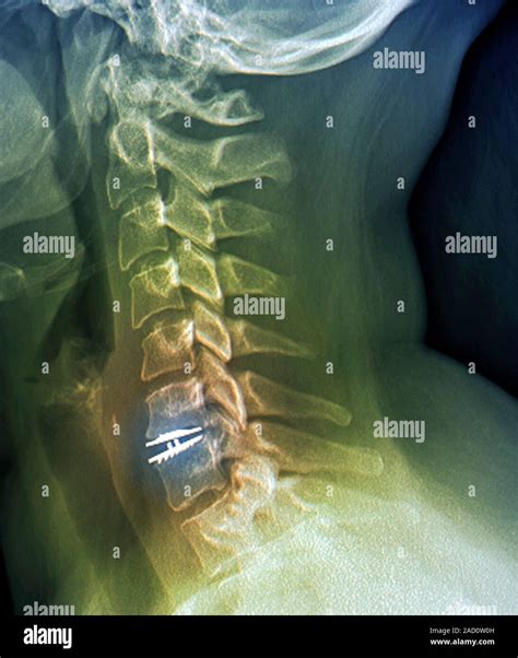 Implant Disque Spinal X Ray D Une Section Par Le Cou D Un 38 Year Old