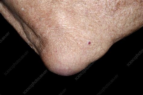 Bursitis Of The Elbow Stock Image C0532493 Science Photo Library