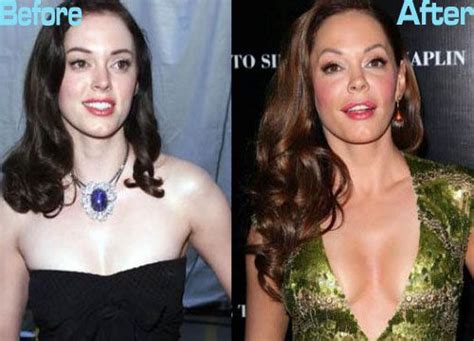 Rose Mcgowan Plastic Surgery Before And After Photos Rose Mcgowan Plastic Surgery Celebrity