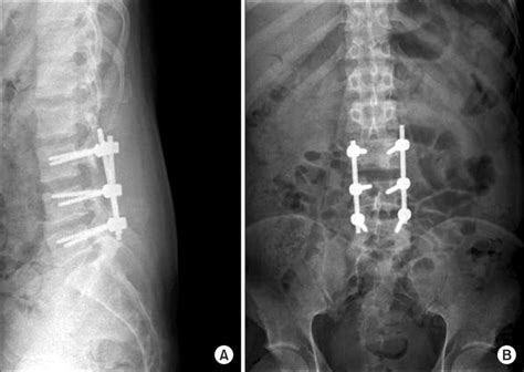 Lumbosacral Spine X Ray Shows A Surgical Intervention Of Posterior