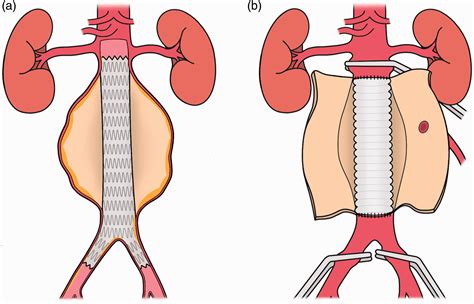 Abdominal Aortic Aneurysms Part Two Surgical Management Postoperative