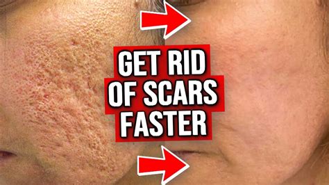 GET RID OF YOUR ACNE SCARS 7 Things You MUST Know YouTube
