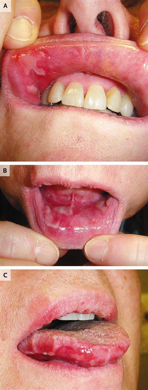 Case 22 2013 — A 51 Year Old Woman With Epistaxis And Oral Mucosal