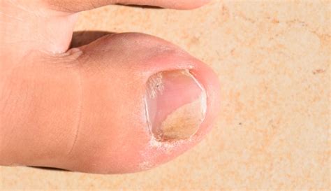 What Causes Toenail Fungus How Can It Be Treated Arizona Foot Doctors