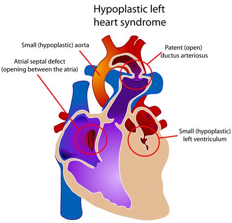 What Is Hypoplastic