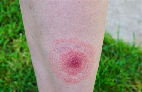 What Does A Tick Bite Look Like