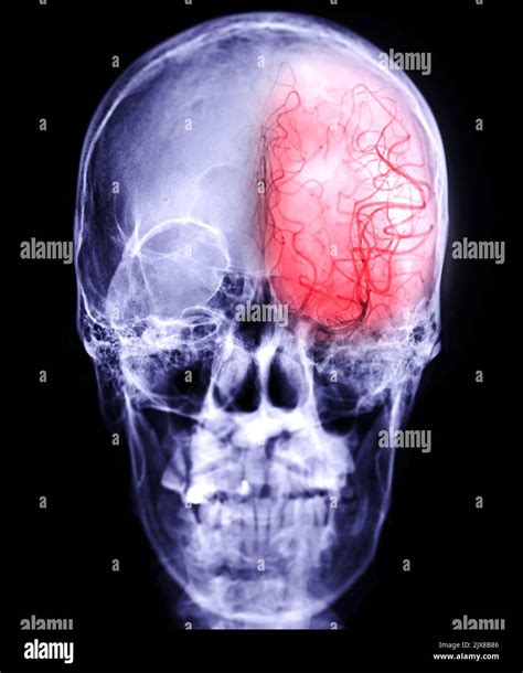 Cerebral Angiography Image From Fluoroscopy With Skull Of Human Showing