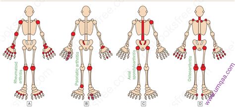 Pin On Fibromyalgia