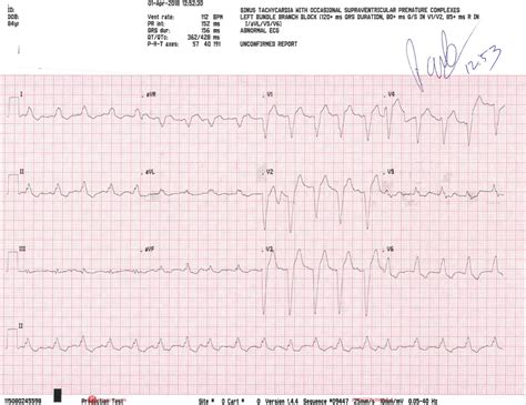 Diagnosis Of Myocardial Infarction In A Patient With Left Bundle Branch Block And Negative