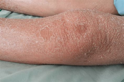 Atopic Eczema Symptom Of Skin Disease Atopic Dermatitis Symptoms