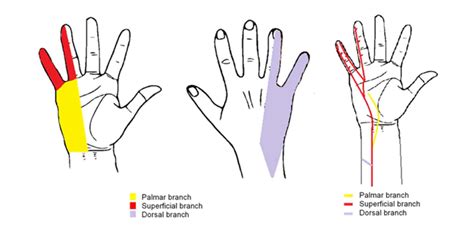 Regional Anaesthesia For Awake Hand Surgery Block Failure And