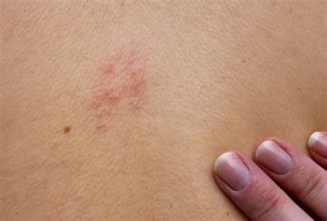 Shingles Herpes Zoster Can Increase Heart Attack Risk In