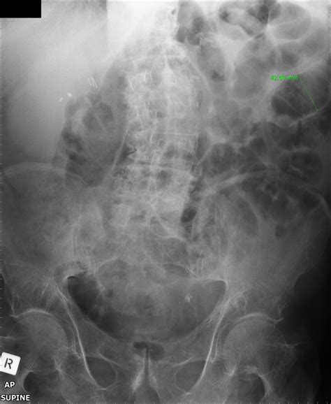 Incisional Hernia Wikiradiography