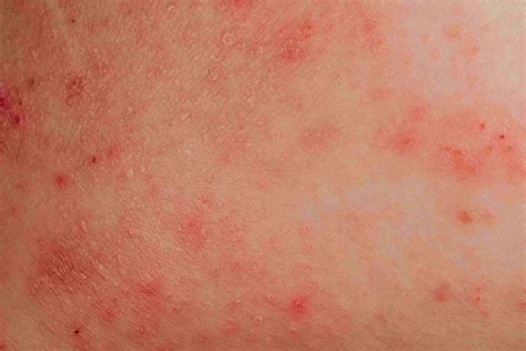 9 Common Rashes With Blisters
