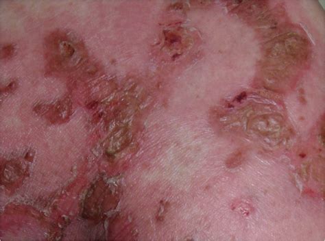 Necrolytic Migratory Erythema As The First Manifestation Of Pancreatic