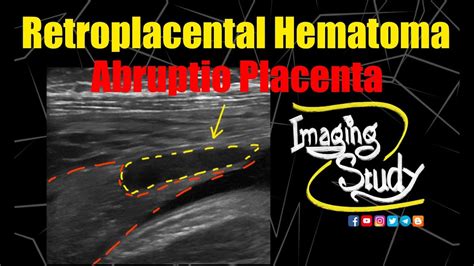 Retroplacental Hematoma Abruptio Placenta Ultrasound Case157