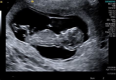 11 Week Ultrasound Babycenter