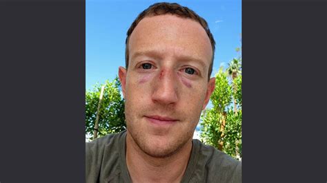 Sports News Mark Zuckerbergs Selfie Reveals Bruises After Unexpected