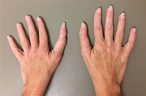 Families Choices And Untreated Triphalangeal Thumbs Congenital Hand