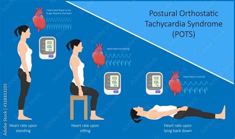 Stockvector Postural Orthostatic Tachycardia Syndrome Pots Intolerance