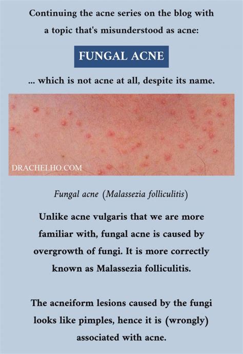 A Simple Guide To Fungal Acne Pityrosporum Folliculitis Off