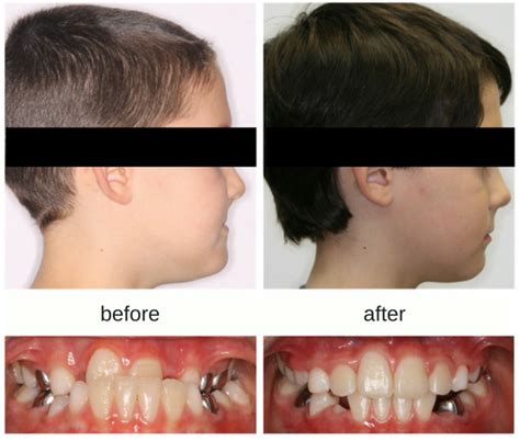 Correcting Underbites In Kids Hometown Orthodontics
