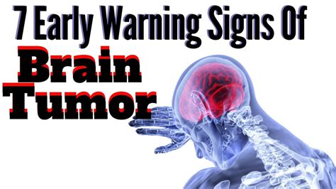 7 Early Warnings Of A Brain Tumor To Never Ignore Sports Health