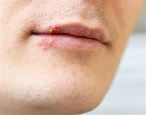 Cold Sores Fever Blisters Clusters Of Small Blisters Causes Treatment