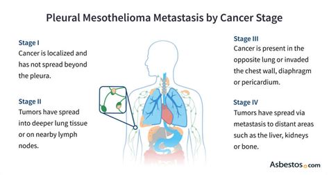 Mesothelioma Metastasis I Factors Affecting Spread