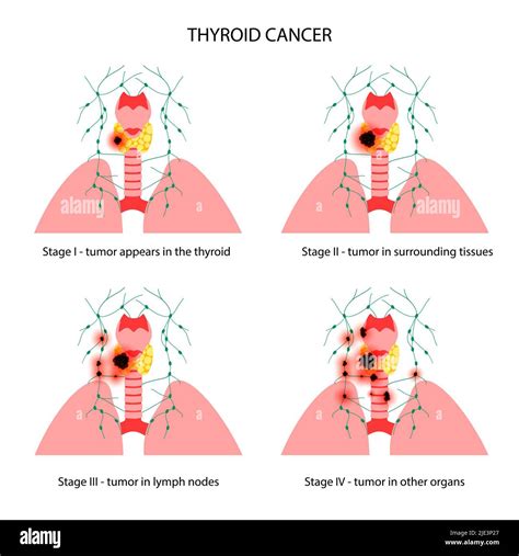 Stades Du Cancer De La Thyroïde Illustration Photo Stock Alamy