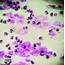High Number Of Polymorphonuclear Leukocytes PMNs In Uterine Cytology 