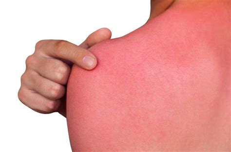 Recognizing And Treating A Sun Allergy Facty Health