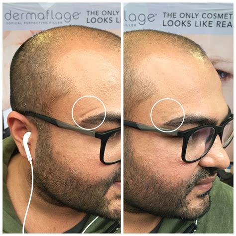 Dermaflage Beforeafter Scar Cover Up Cover Scar Scar Scar Removal