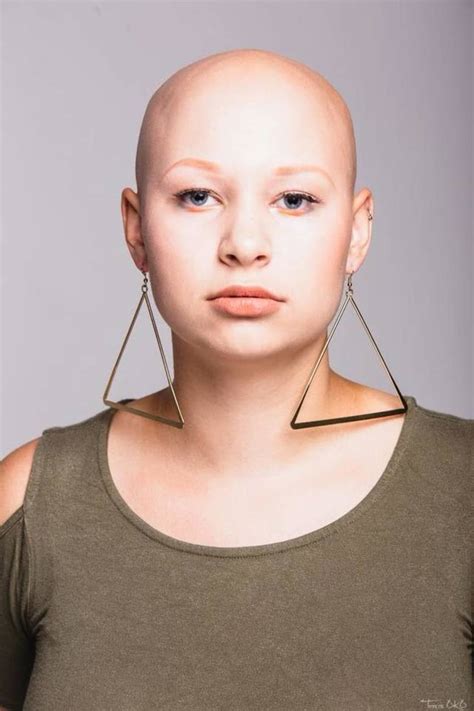 W Mieście Po Raz Pierwszy Będzie Obchodzony Światowy Dzień Alopecji ZdjĘcia Plus