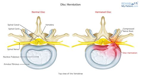 Disc Herniation Rehab My Patient