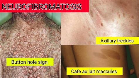 Neurofibromatosis Causes Types Symptoms Diagnosis Treatment