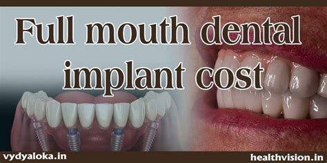 Full Mouth Dental Implants Cost In India Is Much Cheaper And More
