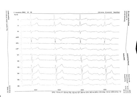 .herzinfarktes ist das aufzeichnen der herzstromkurve durch ein elektrokardiogramm (ekg). Laut EKG Herzinfarkt möglich, bitte um Beurteilung?