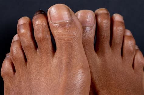 Recognizing Claw Toe Before Its Too Late — Dr James Ricketti And Associates