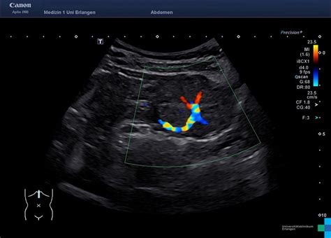 Focal Nodular Hyperplasia Atlas Of Ultrasound
