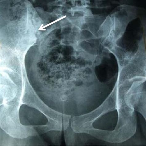 Radiography Of Sacroiliac Joint Ferguson View Showing Right Download Scientific Diagram