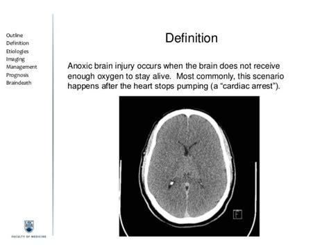 Anoxic Brain Injury And Braindeath Info For Patients Families