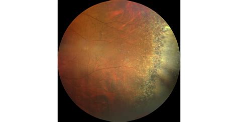What Are These Peripheral Retinal Findings Rophthalmology