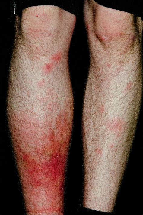 Cellulitis Of The Leg After Insect Bites Photograph By Dr P Marazzi