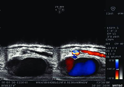 Flow In The Radial Artery Pseudoaneurysm Download Scientific Diagram