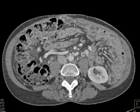 Left Gonadal Vein Thrombosis And Thickened Small Bowel Loops
