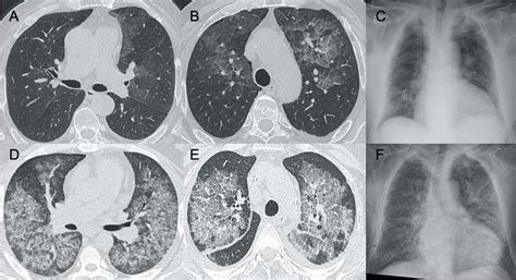 Cytomegalovirus Pneumonia Images In A C Show A Case Of Mild