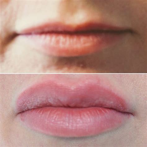 Lips Using 1 Syringe Of Juvéderm Ultra Love These Results