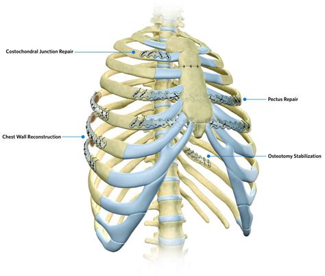 Costochondral Cartilage