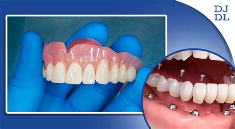 What Are Immediate Dentures Dave Johnson Dental Lab